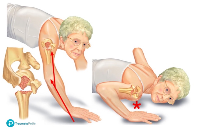 Incapacidad total por fractura de húmero: opiniones en foros Incapacidad total por fractura de húmero: opiniones en foros