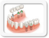 vale la pena estudiar prótesis dental vale la pena estudiar prótesis dental